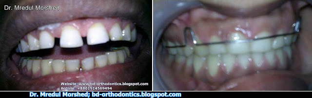 spacing orthodontics