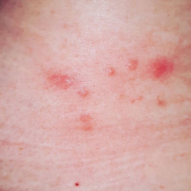 bed bug bites pictures