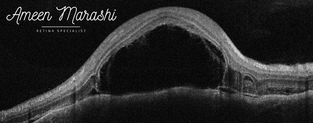 OCT cross-section showing choroidal mass altering chorioretinal contour with subretinal fluids