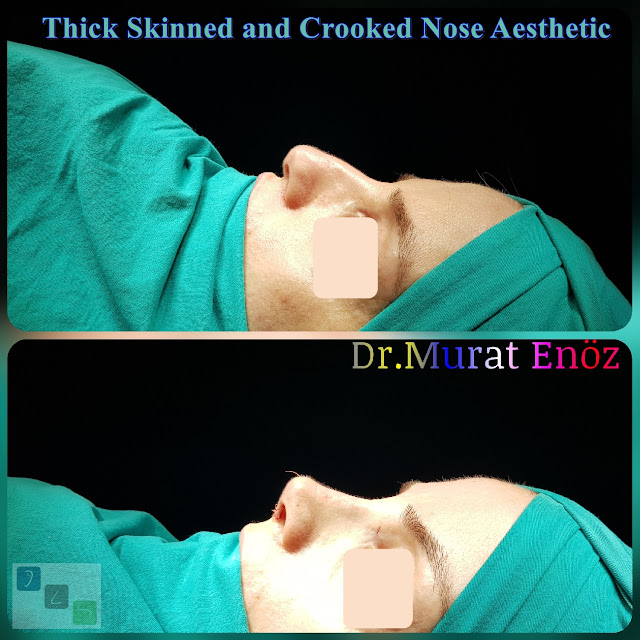 Crooked Nose Aesthetic,Female Nose Job, Rhinoplasty in Istanbul