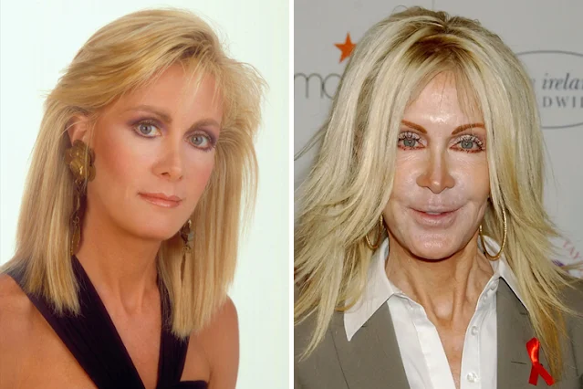 Celebrities who destroyed their faces with plastic surgery: the 10 worst cases of scalpel addicts