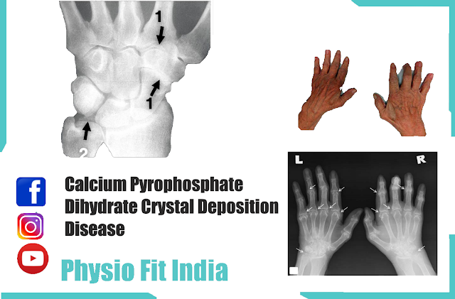 Calcium Pyrophosphate Dihydrate Crystal Deposition Disease