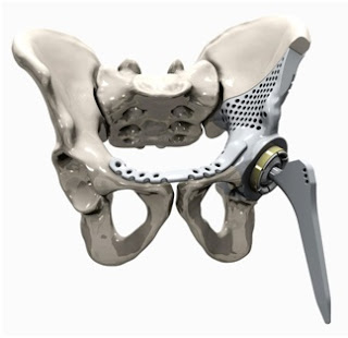 3D Printing of Hip Joint Replacement Implant 