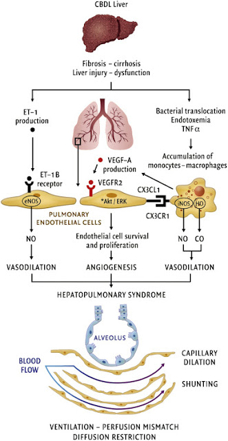 Hepatopulmonary syndrom