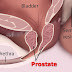 Nursing Interventions for Acute Pain - BPH Benign Prostatic Hyperplasia