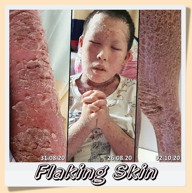 TSW Flaking Skin