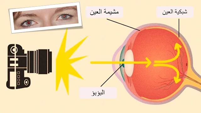 تحدث مشكلة العين الحمراء في الصورة بسبب، إزالة العين الحمراء هي أداة لتحسين عيوب الصورة، سبب العين الحمراء التي تظهر في الصورة، العين الحمراء في مايكروسوفت، تأثير العين الحمراء، سبب ظهور العين بيضاء عند التصوير، انعكاس فلاش الكاميرا على العين، إصلاح العين الحمراء في الصور بواسطة برنامج
