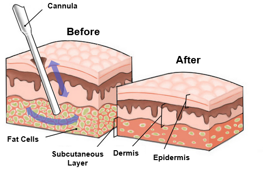 Successful Liposuction Surgery