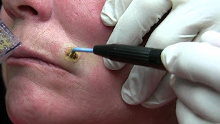 Mole removal through Diathermy