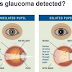 Glaucoma - affects and treatment - of this disease