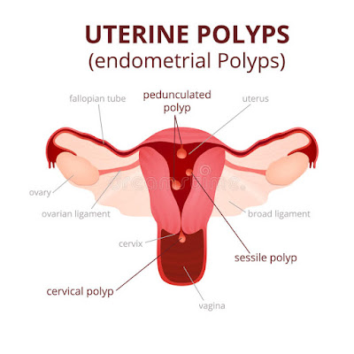 hysteroscopy for polyps removal