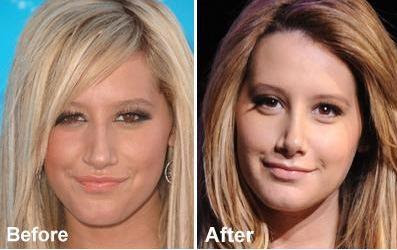 ashley_tisdale_nose_job_before_and_after.jpg