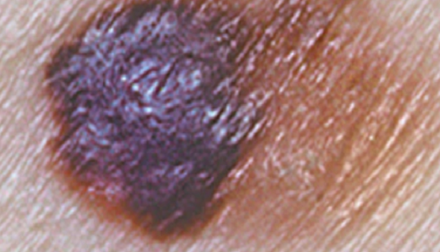 malignes melanom Asymmetrie frühstadium bilder