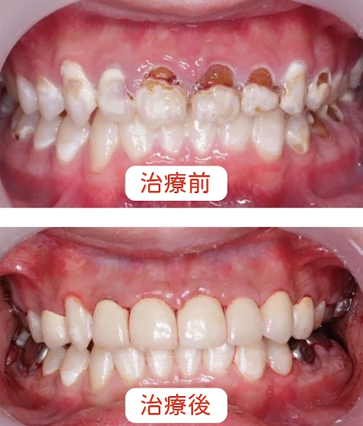 ▲小杰全口有28顆齲齒，其中10顆牙齒需要進行根管治療，同時有殘根需拔除。為解決看牙焦慮，中醫大兒醫牙科跨專科團隊以全身麻醉進行全口重建，幫助小杰恢復自信。（中醫大兒醫提供）