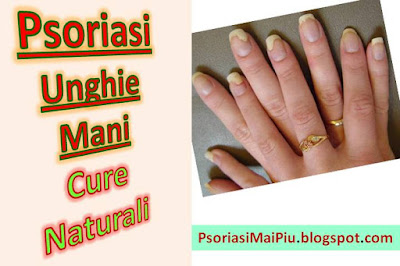 psoriasi-ungueale-cura-naturale-alle-unghie-rimedi-naturali