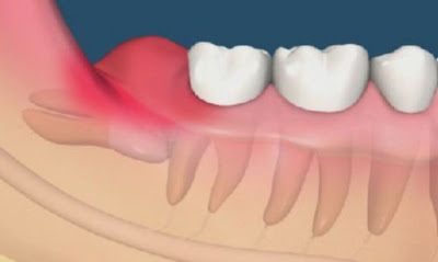 Răng khôn hàm dưới mọc lệch