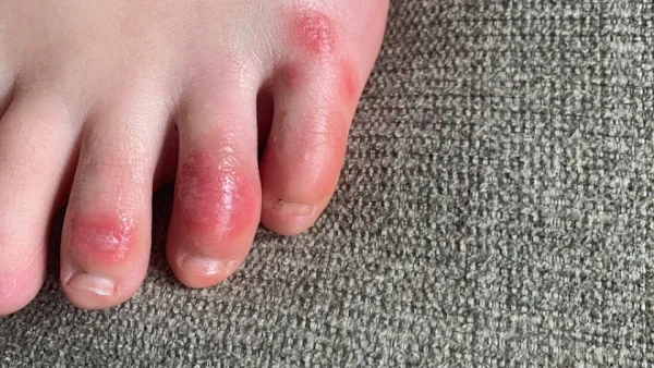 Coronavirus symptoms: Toes