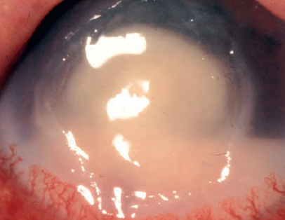 Bacterial corneal ulcer and its complication
