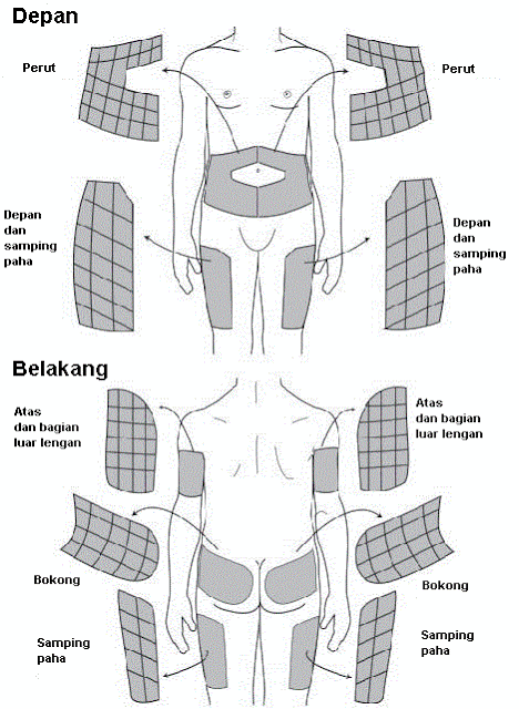 di mana tempat injeksi insulin