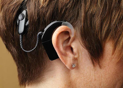 Points to Do after Cochlear Implant in Singapore