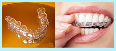 Niềng răng Invisalign ở đâu hiệu quả?