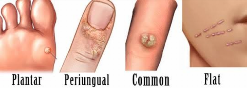 Warts Amp Corns Quot عين السمكة أو السنط Quot