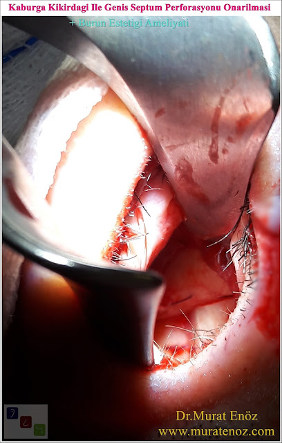 Nazal septum perforasyonu - Septum perforasyonu ameliyatı olanlar - Septum perforasyonu olanlar - Septum perforasyonu ameliyatı yapan doktorlar - Burunda delik oluşumu - Burun duvarında delik - Burun kıkırdak delinmesi tedavisi - Septum perforasyonu ameliyatı olanlar - Septum perforasyonu olanlar - Septal perforasyon tamiri - Septal buton uygulaması - Nazal septum perforasyonu tedavisi - Nazal septum perforasyonu nedenleri - Nazal septum perforasyonu belirtileri - Septum perforasyonun cerrahi onarımı - Burun delinmesinin nedenleri - Nazal septum perforasyonu tanısı - Erkek burun estetiği - Burun estetiği ameliyatı - Definition of Nasal Septal Perforation - Causes of Perforated Nasal Septum - Symptoms of Nasal Septal Perforation - Diagnosis of Nasal Septal Perforation - Surgical Treatment For Nasal Septal Perforation - Nasal Septal Perforation Repair - Surgical Repair of Nasal Septal Perforation