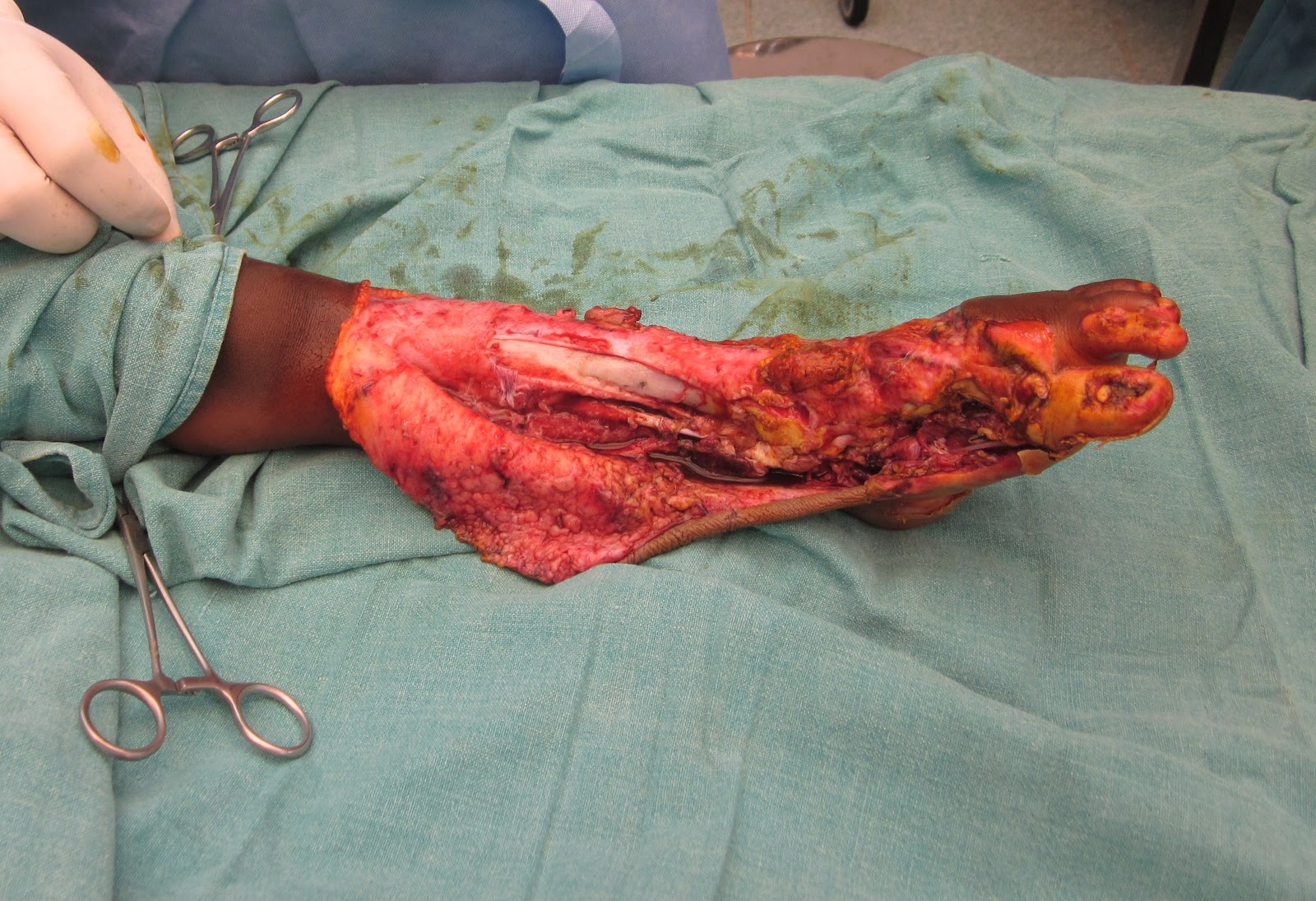 CRUSH INJURY FOOT, LOWER LIMB INJURIES AND LIMB SALVAGE: MAJOR CRUSH INJURY  LEG AND FOOT - FREE TISSUE TRANSFER- LOWER LIMB INJURY