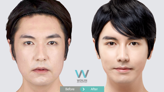 Korean plastic surgery