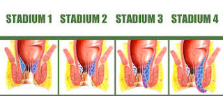 wasir setadium 1, wasir setadium 2, wasir setadium 3 , wasir setadium 4