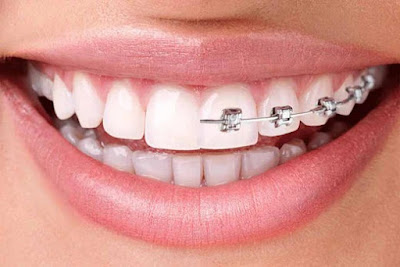 Benefits of clear aligners over braces