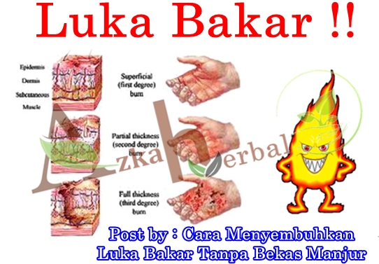 Cara Menyembuhkan Luka Bakar Tanpa Bekas Manjur