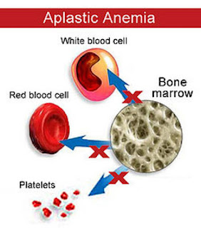 ubat anemia