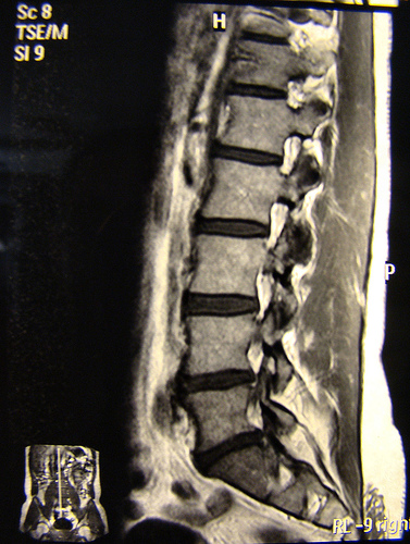 herniated lumbar disc. a herniated lumbar disc to