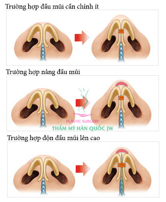 thu-nho-dau-mui-tai-jw-gia-bao-nhieu-2