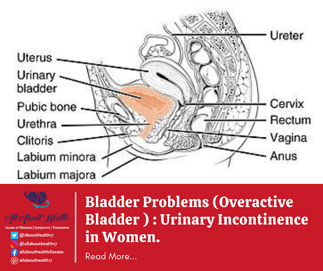 Bladder Problems (Overactive Bladder ) : Urinary Incontinence in Women.