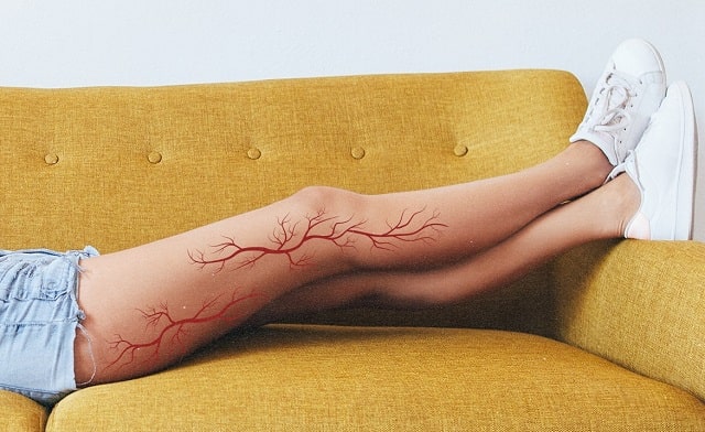 sclerotherapy treatment spider veins before they turn into varicose veins