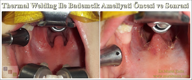 Thermal welding bademcik ameliyatı öncesi ve sonrası fotoğrafları - Thermal welding yöntemi ile bademcik ameliyatı öncesi ve sonrası görselleri - Thermal welding tonsillektomi - Thermal welding kansız bademcik ameliyatı öncesi ve sonrası - Kansız bademcik ameliyatı