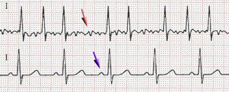 心房顫動 Atrial fibrillation, Af