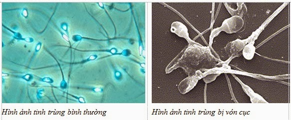 Tinh trùng bị vón cục màu vàng nhạt có bị làm sao không ?