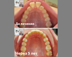 Форма зубного ряда до и после ортодонтического лечения