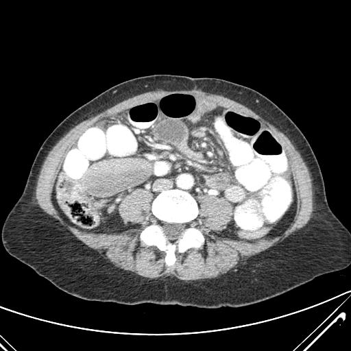 Bowel obstructions in Roux-n-Y gastric bypass patients always make 