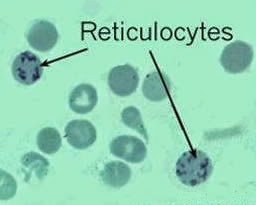 Anémie inflammatoire pdf