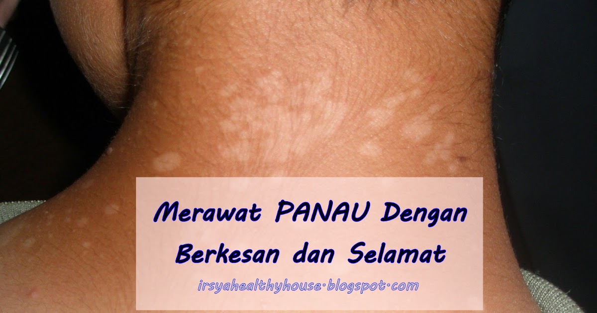 Hilangkan Panau di Muka dan Badan Dengan Berkesan, Elakkan 