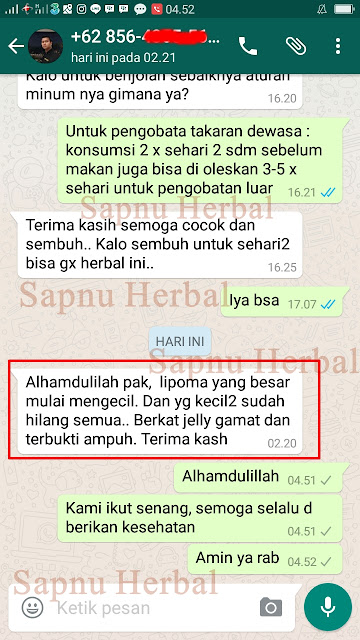 Obat Benjolan di Kaki / di Tangan | 100 % ALAMI dan MUJARAB