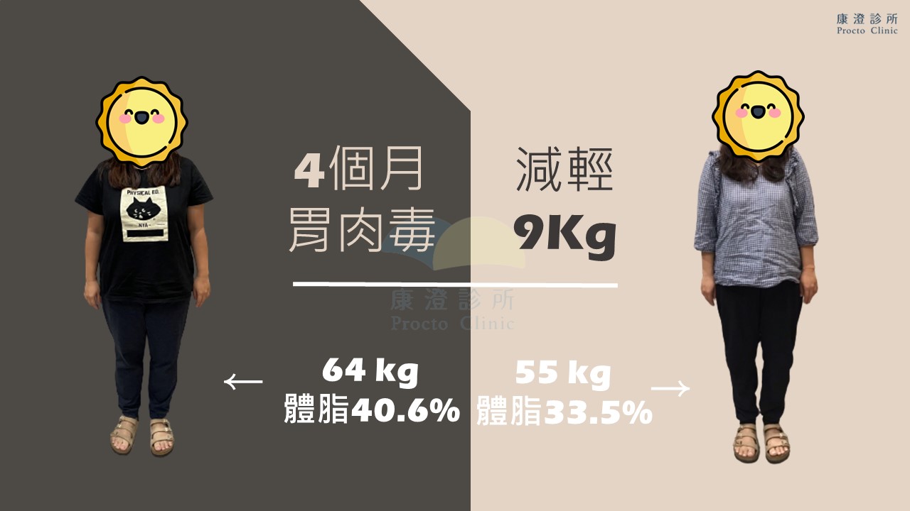 4個月胃肉毒減重，這位個案從64公斤、體脂40.6%，減輕了9公斤，現為55公斤、體脂33.5%。