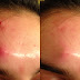 How To Pop a Pimple - Home Remedy