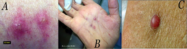 El sarcoma de Kaposi 2. En las fotos anteriores presentamos algunos tipos de lesiones por sarcoma: (A) pápulas, (B) máculas y (C) nódulos. Originalmente el sarcoma de Kaposi se presentaba en otras poblaciones distintas a las del mediterráneo o europa del este cuando la inmunosupresión era mediada por medicamentos como las ciclosporinas necesarias para el trasplante exitoso de órganos, debido a la incompatibilidad tisular entre donante y receptor.