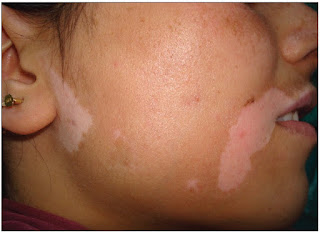 https://skincareayurveda.com/vitiligo-treatment-in-ayurveda/