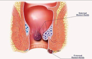 Artikel, Ambeien, Ambeien Adalah, Gejala Ambeien, Resiko Terkena Ambeien, Pengobatan Ambeien
